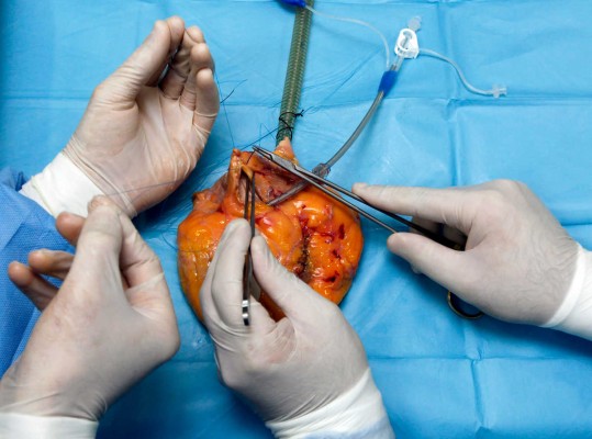 El 75% de los pacientes que sale de lista de espera de trasplante cardiaco fallece

