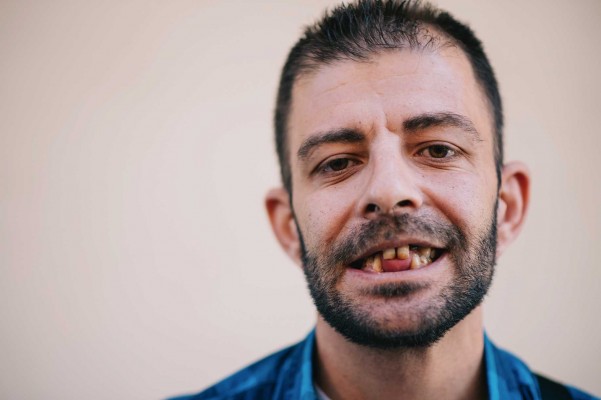 Dientes que cuestan un ojo de la cara